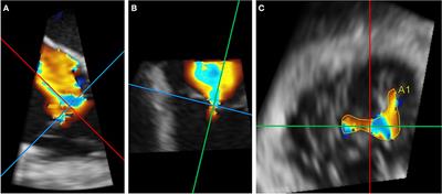 Imaging and Patient Selection for Transcatheter Tricuspid Valve Interventions